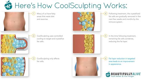 CoolSculpting: How to Prepare, Procedure, Cost, .